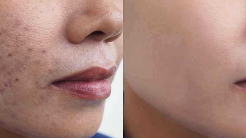 ব্রণ ও ব্রণের দাগ দূর করার ঘরোয়া উপায়