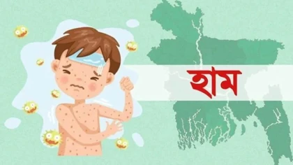 হাম ও হামের উপসর্গে আরও ২ শিশুর মৃত্যু