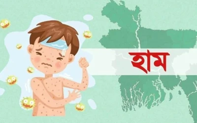 হামের উপসর্গে দেশে আরও ৭ শিশুর মৃত্যু